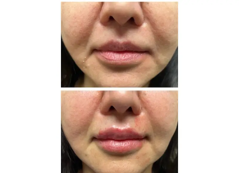 Juvederm Washington DC