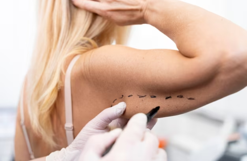 stretch mark microneedling