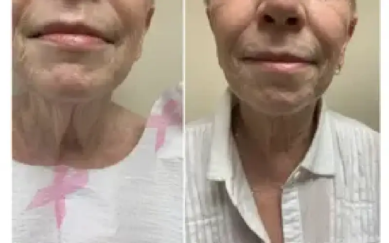 coolsculpting neck cost