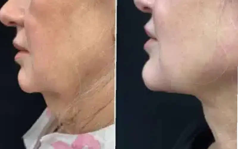 coolsculpting neck cost