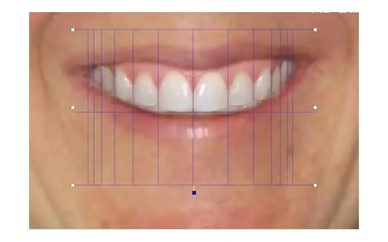 full arch dental implants