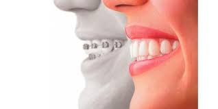 Retainer After Braces