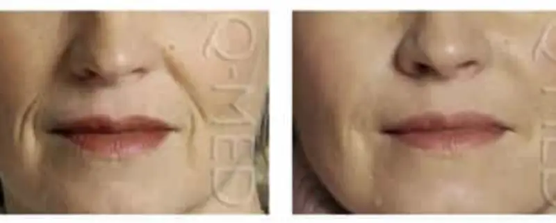 Juvederm Washington DC