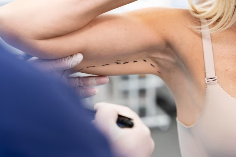 stretch mark microneedling