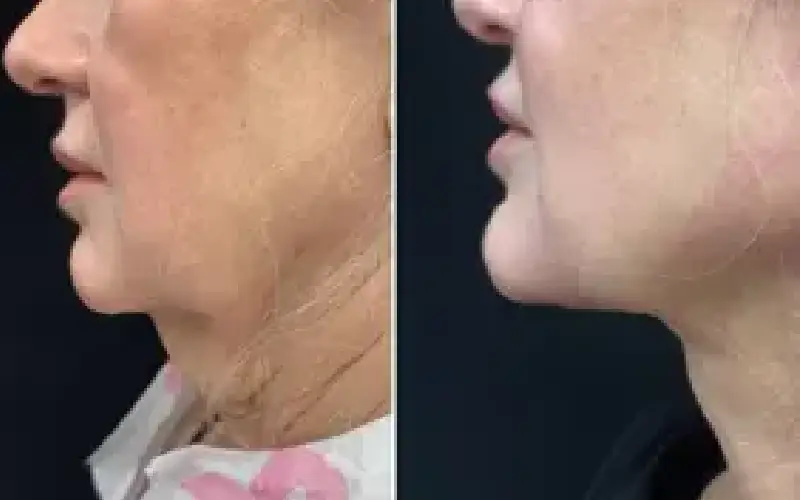 coolsculpting neck cost