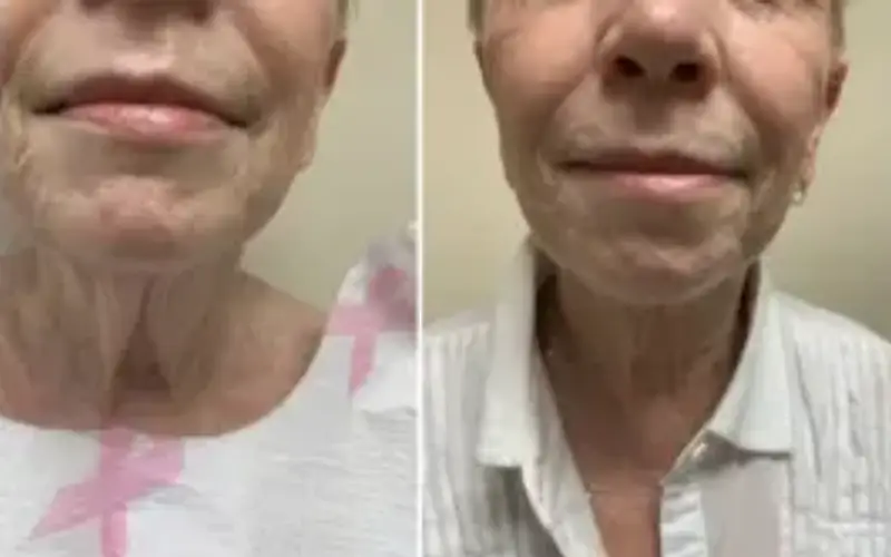 coolsculpting neck cost