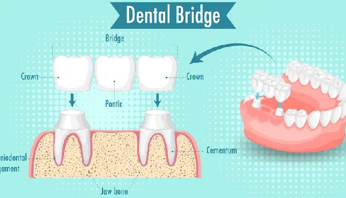 all on 4 dental implants pembroke pines