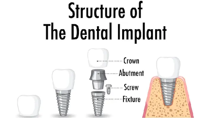 all on 4 dental implants pembroke pines