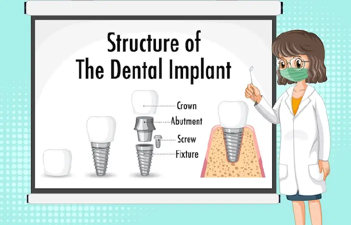all on 4 dental implants pembroke pines